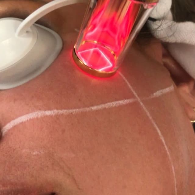 RINOVARE FRAXEL LASER at Remake Beauty Studio San Juan in San Juan, TX